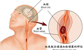 紅葡萄酒可以有效預(yù)防中風后腦損傷